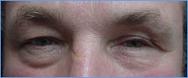 prothese oeil accident domestique