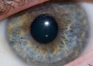 lentilles souples en hydrogel