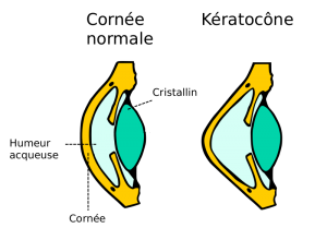 Kératocône-adaptation lentilles rigides