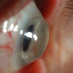 Bien comprendre le principe d'adaptation des lentilles rigides chez les patients atteints d'un Kératocône