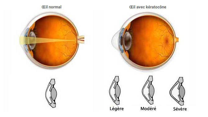 evolution et stades du keratocone