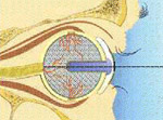 Prothèse oculaire sur implant