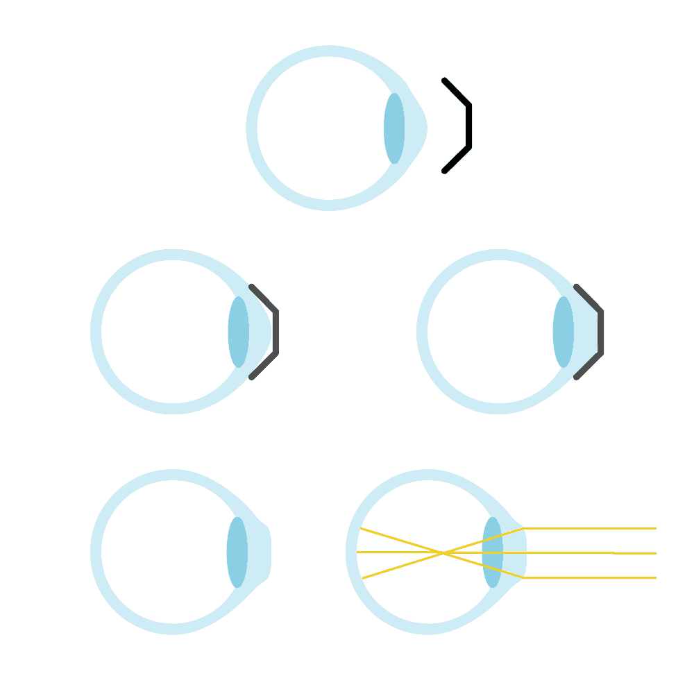 lentilles Orthokeratology