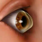 Déformation de la cornée : causes, symptômes et traitement
