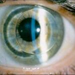 Tout savoir sur les lentilles rigides