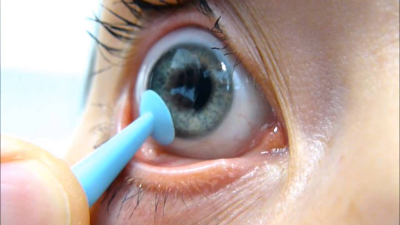 Quel est l int r t d adapter des lentilles rigides Actualit s
