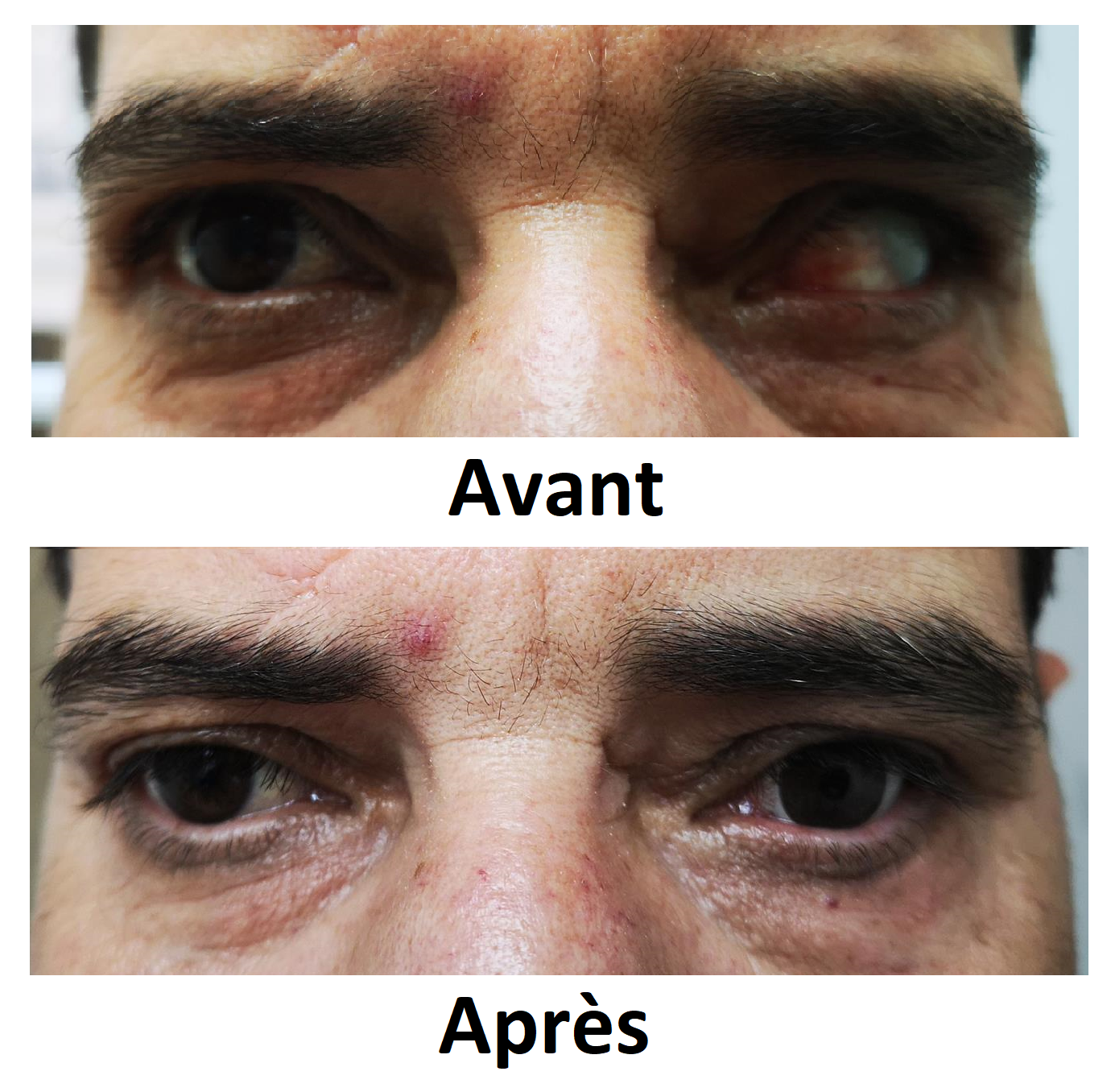 exemple de realisation du verre sclérale par dencott