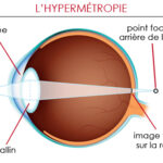 Peut on porter des lentilles quand on est hypermétrope ?