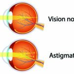 Qu'est-ce qu un œil astigmate et comment le corriger avec des lentilles de contact ?