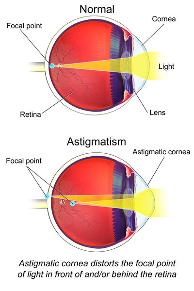 Comment corriger la vision d'un astigmate avec des lentilles de ...