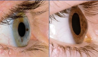 correction keratocone