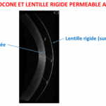 Quelles lentilles pour corriger le kératocône ?