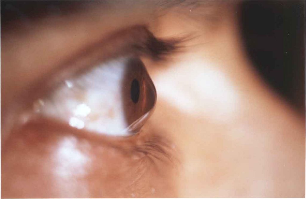 oeil atteint du keratocone