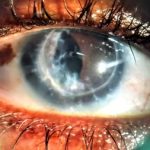 Lentille rigide sur mesure de spécialité