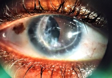 Greffe OD traitement avec lentilles rigides