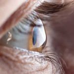 J’ai un kératocône : voici comment les lentilles m’ont changé la vie