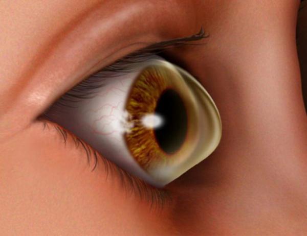 Le frottement oculaire est-il une des causes du kératocône ?