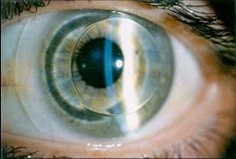 Tout savoir sur les lentilles rigides