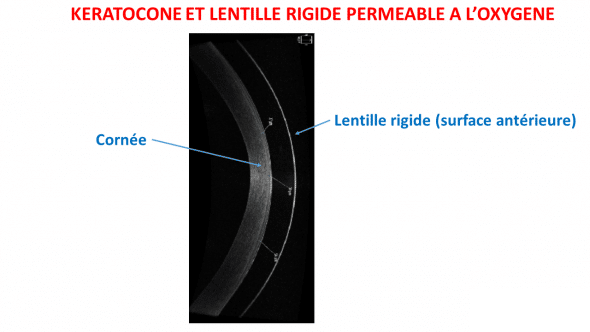 Quelles lentilles pour corriger le kératocône ?