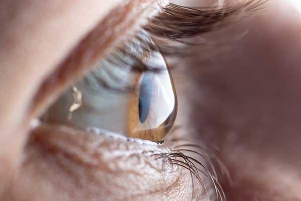 J’ai un kératocône : voici comment les lentilles m’ont changé la vie