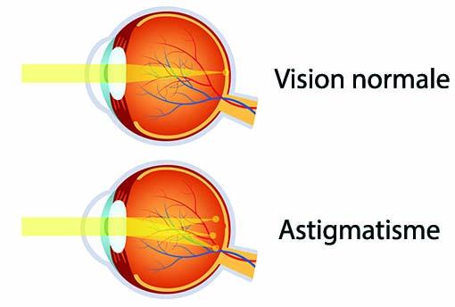 Qu'est-ce qu un œil astigmate et comment le corriger avec des lentilles de contact ?