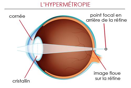 Peut on porter des lentilles quand on est hypermétrope ?