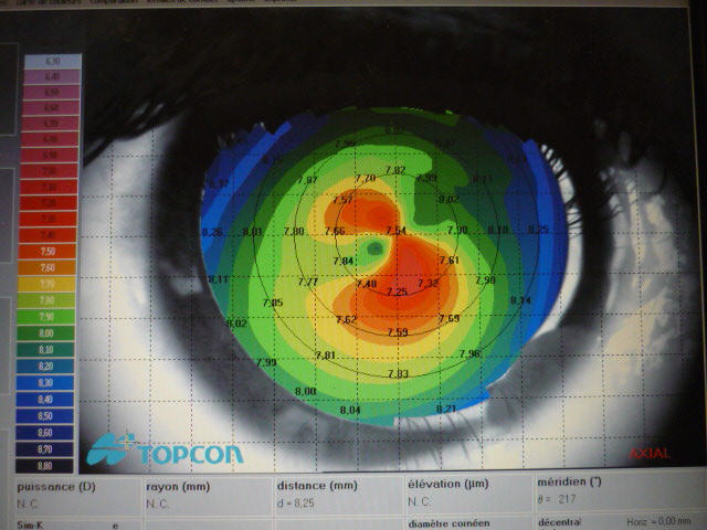 lentille K&eacute;ratoc&ocirc;ne laboratoire Dencott mesure