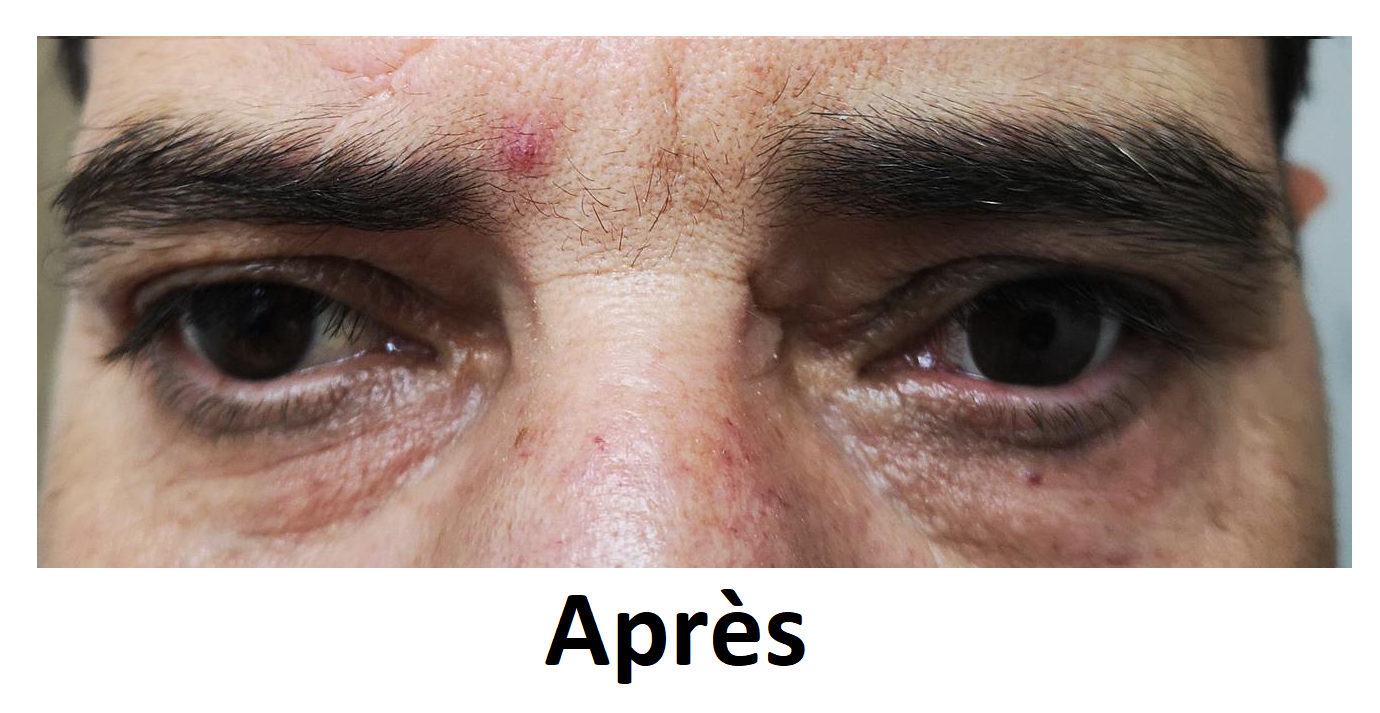 realisation dencott apres lentille sclerale souple