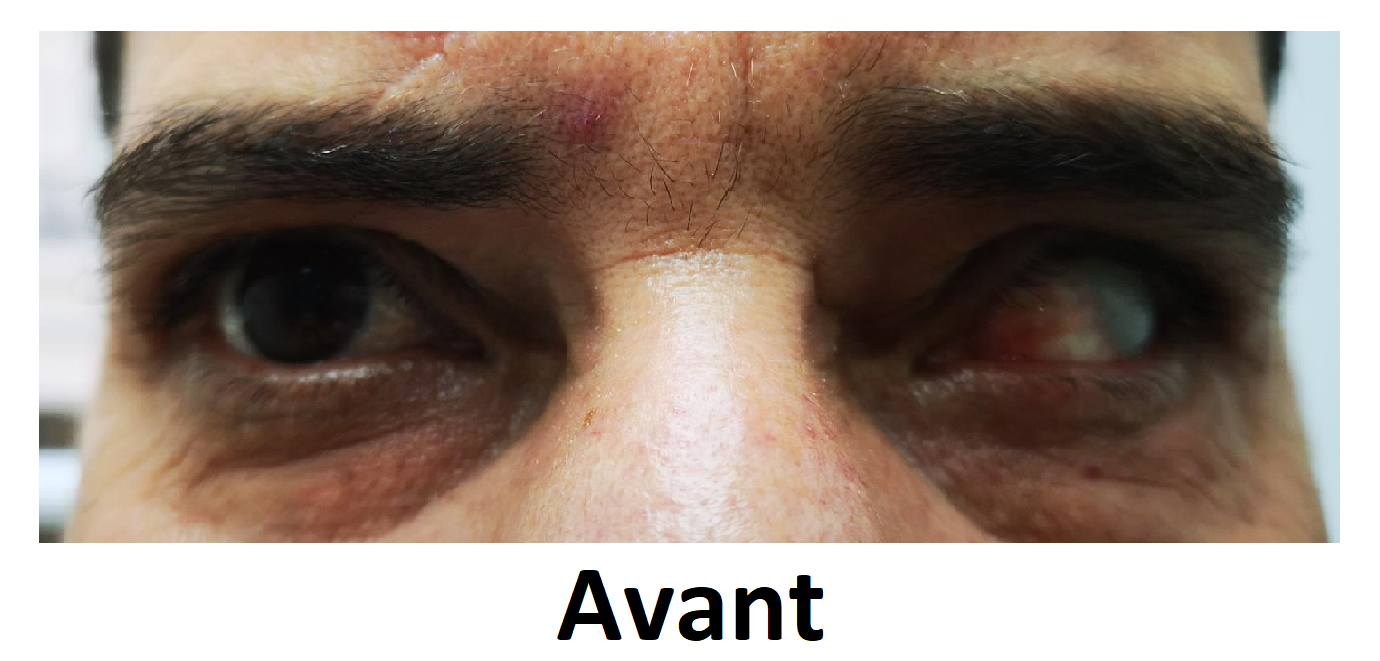 realisation dencott avant lentille sclerale souple