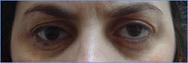 Prothese oculaire laboratoire Dencott Apres 1