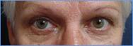 Prothese oculaire laboratoire Dencott Apres 2