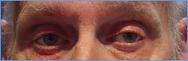 Prothese oculaire laboratoire Dencott Apres 4