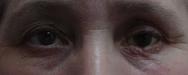 Prothese oculaire laboratoire Dencott Apres 5