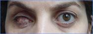 Prothese oculaire laboratoire Dencott Avant 1