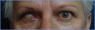 Prothese oculaire laboratoire Dencott Avant 2
