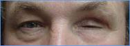 Prothese oculaire laboratoire Dencott Avant 3