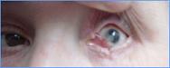 Prothese oculairelaboratoire Dencott Avant 5