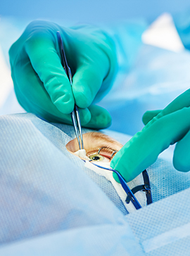 Lentille après chirurgie réfractive et greffe laboratoire Dencott Lentille après chirurgie réfractive et greffe laboratoire Dencott