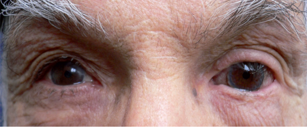lentille rigide à iris peint avec pupille optique