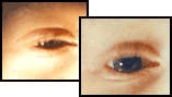 Reconstruction de l'iris et lentilles pour albinisme